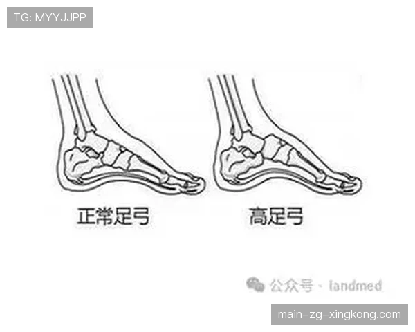 足部重塑:篮球鞋造成的畸形与手术,篮球鞋足弓凸起 足部重塑:篮球鞋造成的畸形与手术,篮球鞋足弓凸起